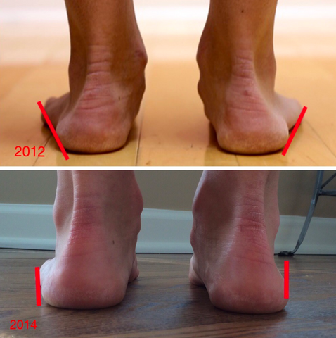 Participant foot strength while wearing zero drop shoes increased to reduce "duck-footedness"