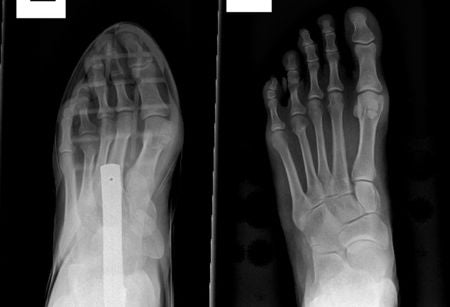 Shoes with tapering toe boxes can cause foot deformities like bunions and hammertoes.