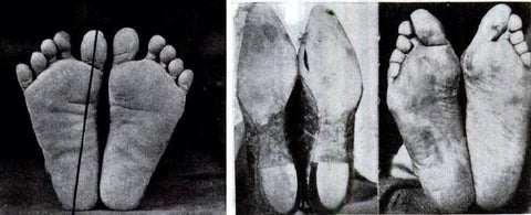 Damaging effects of improper footwear over time.