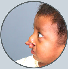 501c3 nonprofit in NYC Developing Faces birth deformity