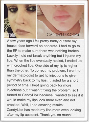 Asymmetrical Lips Correction