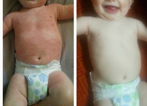 Baby skin allergie
