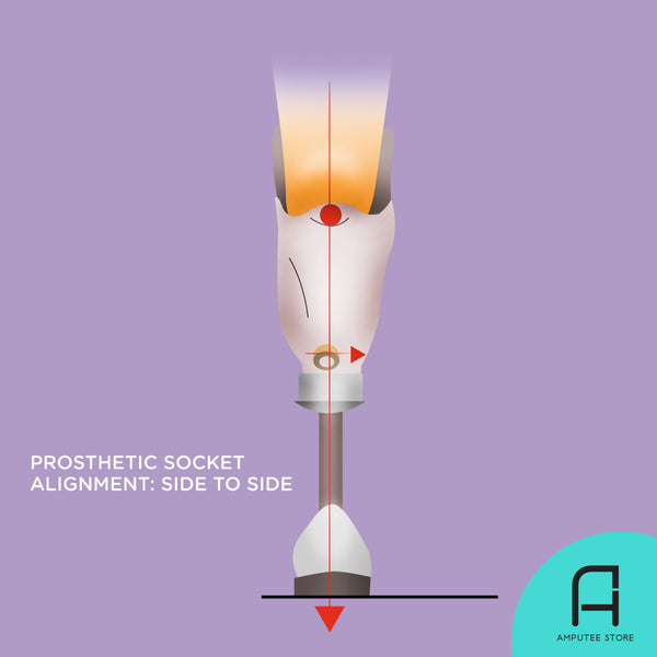 An illustrated below-knee amputee with prosthesis shows how to determine correct socket alignment when inspected from side to side.