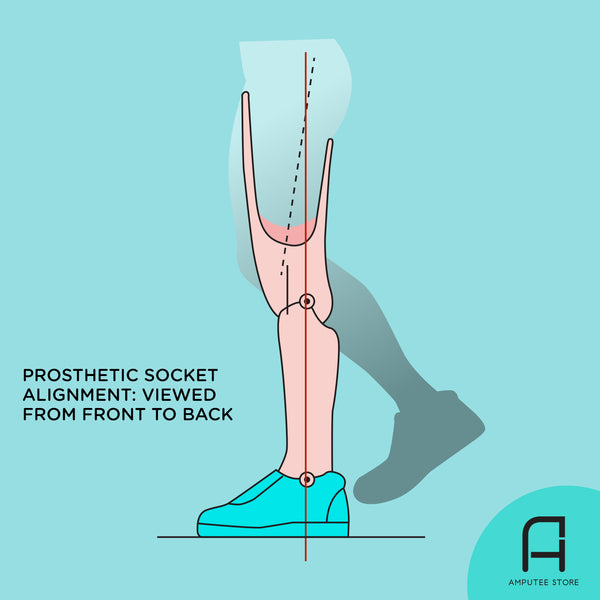 An illustration of a residual limb attached to a below-the-knee prosthetic leg to illustrate the ideal prosthetic socket alignment viewed from front to back.