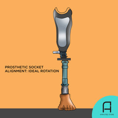 How to determine the ideal prosthetic socket alignment and rotation using your phone's measuring or photo editing app.