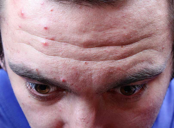 Acne Pimples on Face and Forehead