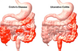 Ray_Sahelian_Ulcerative_Colitis_and_Curcumin