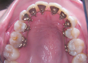 Lingual Braces Case Studies | Oldham | Manchester Orthodontics