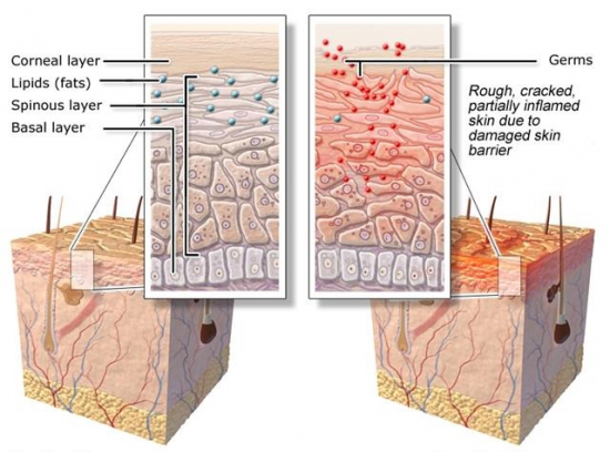 LEFT: Healthy skin. RIGHT: Dry skin. Image from informedhealthonline.