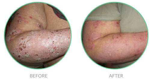 Extreme case of psoriasis before and after