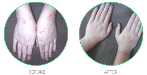 Renucell for Eczema on Hands