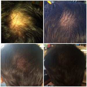 Zenagen Hair Loss Before & After