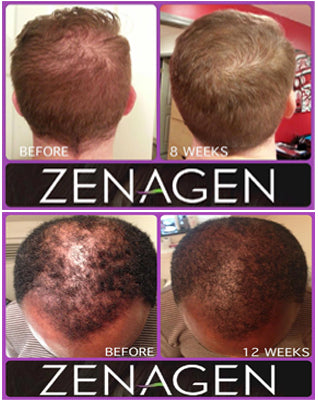 Zenagen user before and after