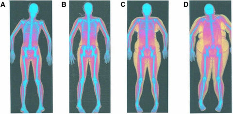 Radiografía de una persona con diferentes grados de obesidad 