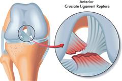 ACL ligament Anterior Crutiate Ligament Tear Surgery