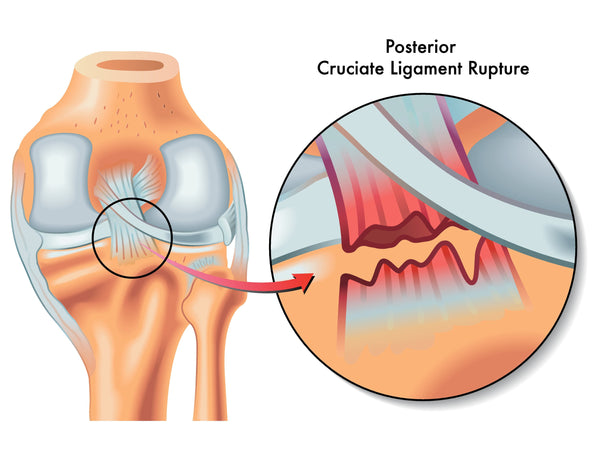 Dashboard Knee Injury PCL Tear Causes Symptoms Healing Time