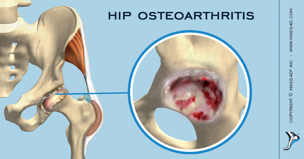 Understanding Hip Osteoarthritis - MASS4D® Foot Orthotics