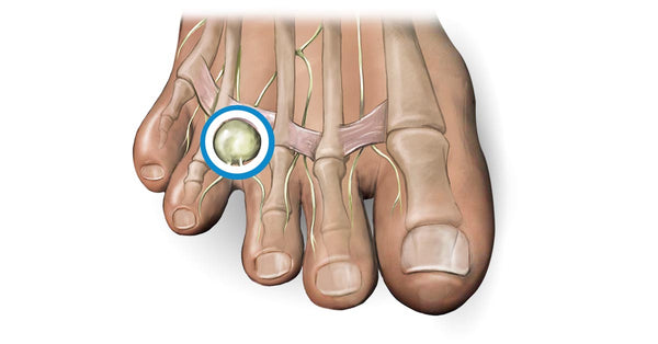 morton's neuroma insoles for shoes