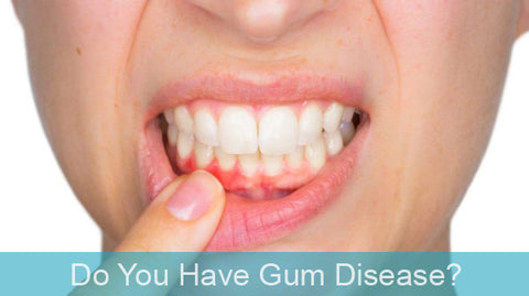 Do you have gum disease