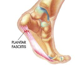 How Orthotic Insoles Can Help Plantar 