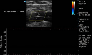 OMNA Tourniquet: Before - During - After Application