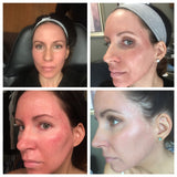 Sciton laser profractional