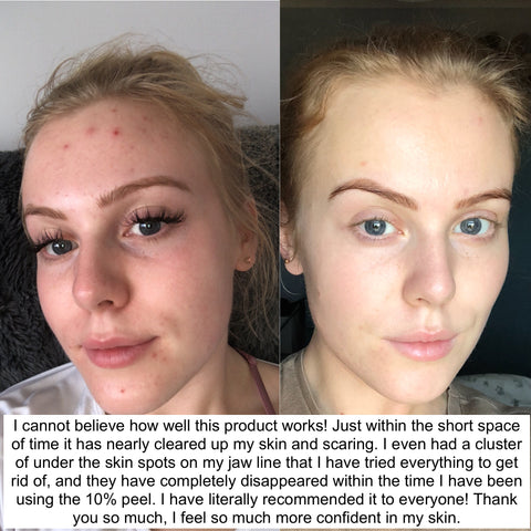 chemical peel before and after