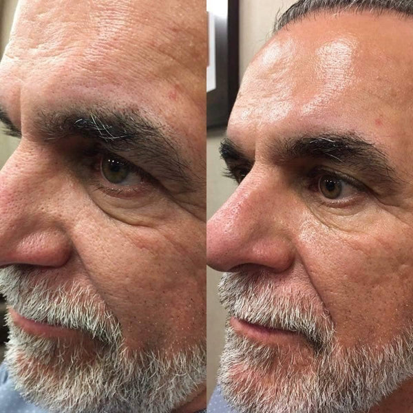 lumispa before and after wrinkles