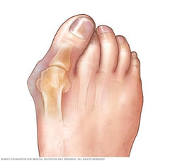 What does a bunion look like? Photo from Mayo Clinic