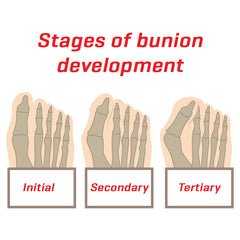 Bunion development