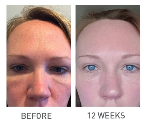 Advanced Correcting Serum with Illuminotex Before and After