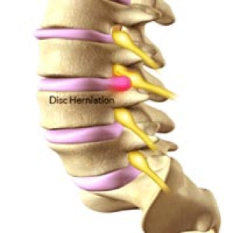Disk Herniation can Cause Back Pain