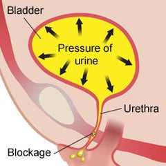 Overflow incontinence False incontinence associated with urinary retention