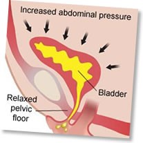 Stress incontinence image of bladder with relaxed pelvic floor