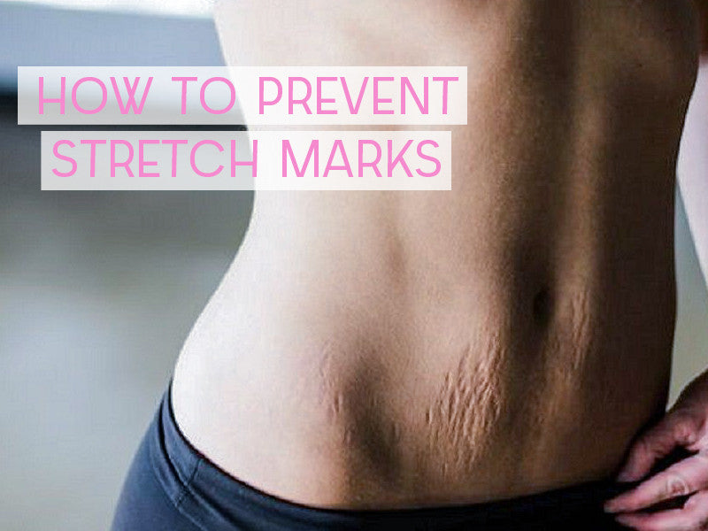 How To Prevent Stretch Marks