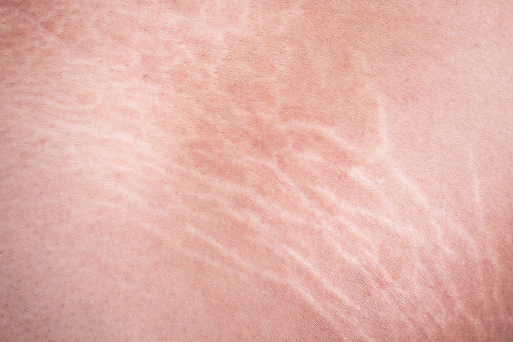 how to prevent stretch marks