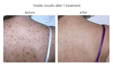 IPL-Dark-Spot-Age-Spot-Pigment-treatment