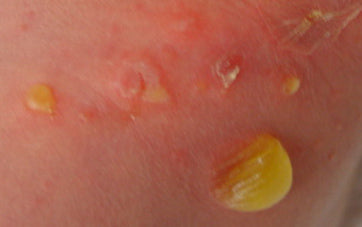 Large cloudy blisters, staph infection