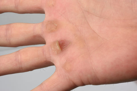 Crosfit Hand Calluses