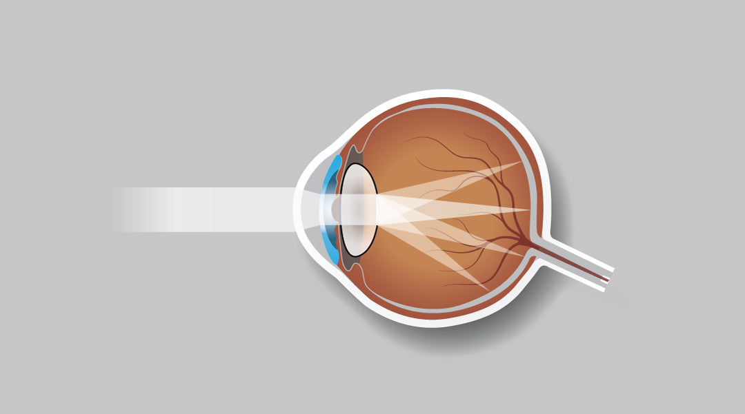 What is the main cause of astigmatism