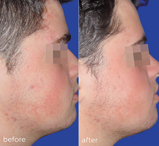 homecare-acne-before-after