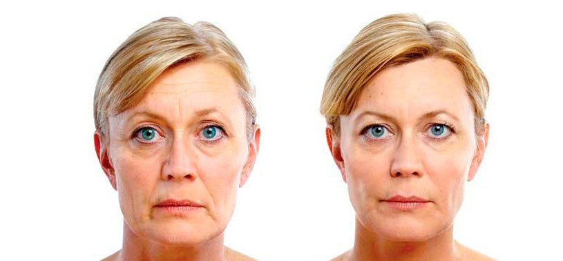 tratamiento para eliminar las arrugas del rostro
