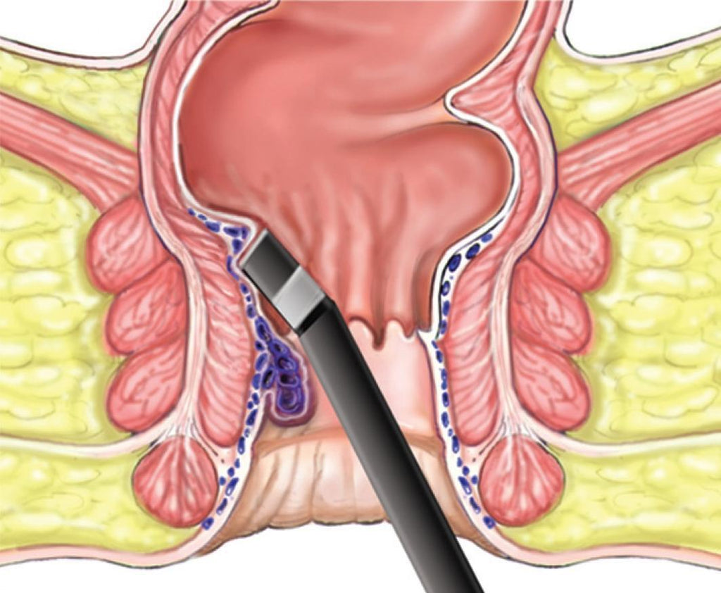 Hemorrhoid herpes anus