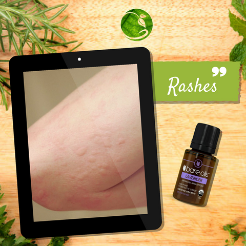 Rashes