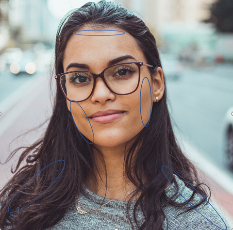 woman face with circles around acne prone zones from a cause of oily hair products