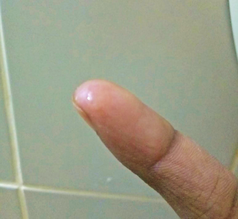 fingertip has a droplet of peel to apply