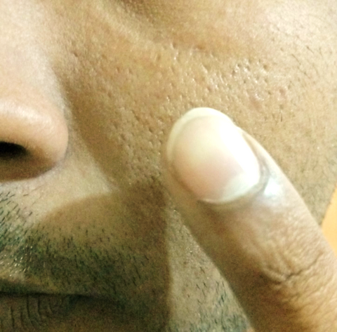 the finger is applied to the cheek where the scarring is