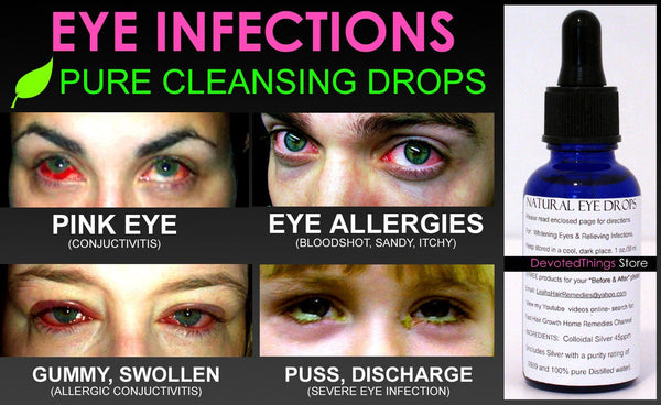 Natural Eye Drops For Pink Eye And Eye Infections For Healthy Bright Eyes Devotedthings 