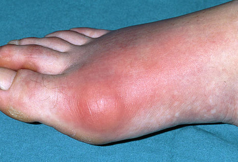 Gout toe - TheHerbalDoctors