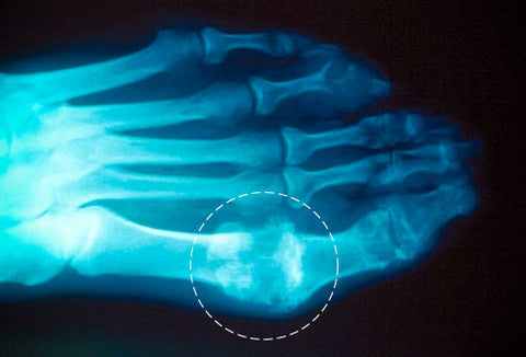 Gout xray TheHerbalDoctors